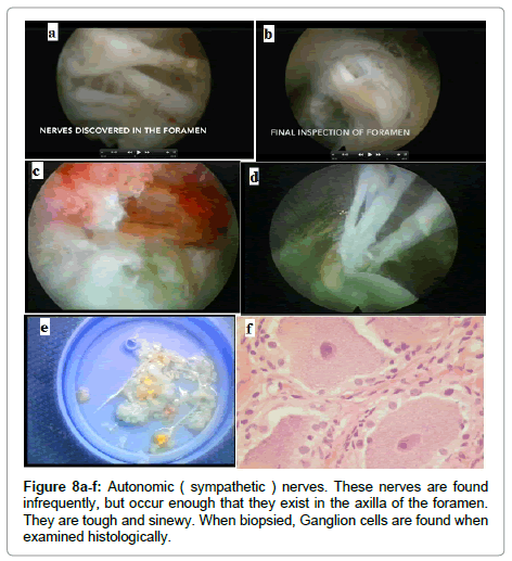 spine-neurosurgery-Ganglion-cells