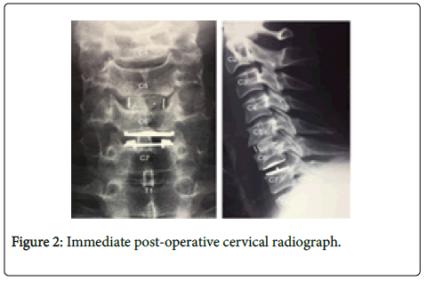 spine-neurosurgery-Immediate-post