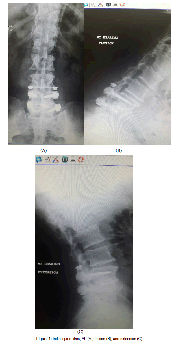 spine-neurosurgery-Initial-spine
