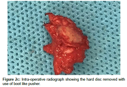 spine-neurosurgery-Intra-operative