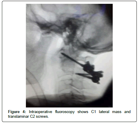 spine-neurosurgery-Intraoperative-fluoroscopy
