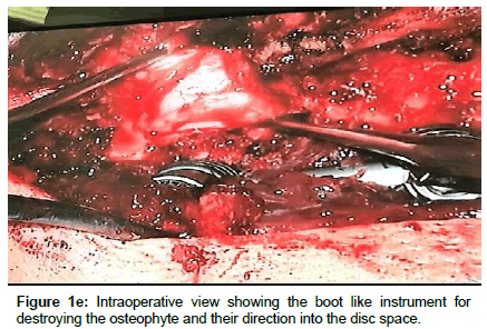 spine-neurosurgery-Intraoperative-view