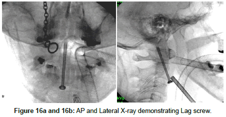 spine-neurosurgery-Lag-screw