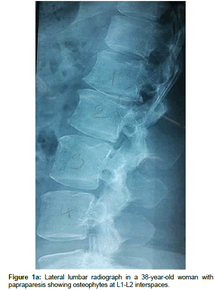 spine-neurosurgery-Lateral-lumbar