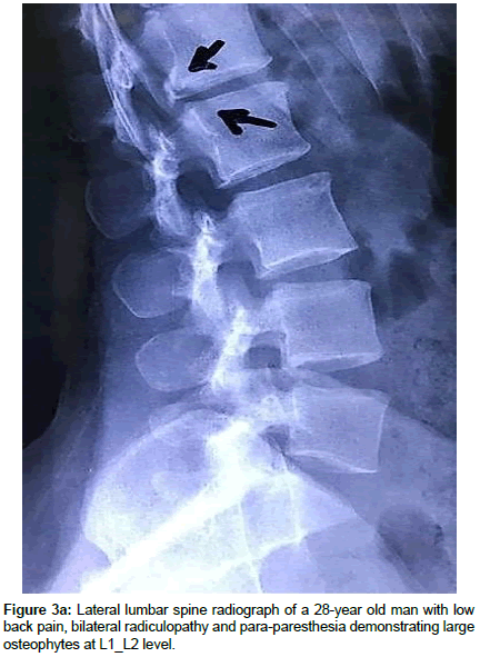 spine-neurosurgery-Lateral-lumbar