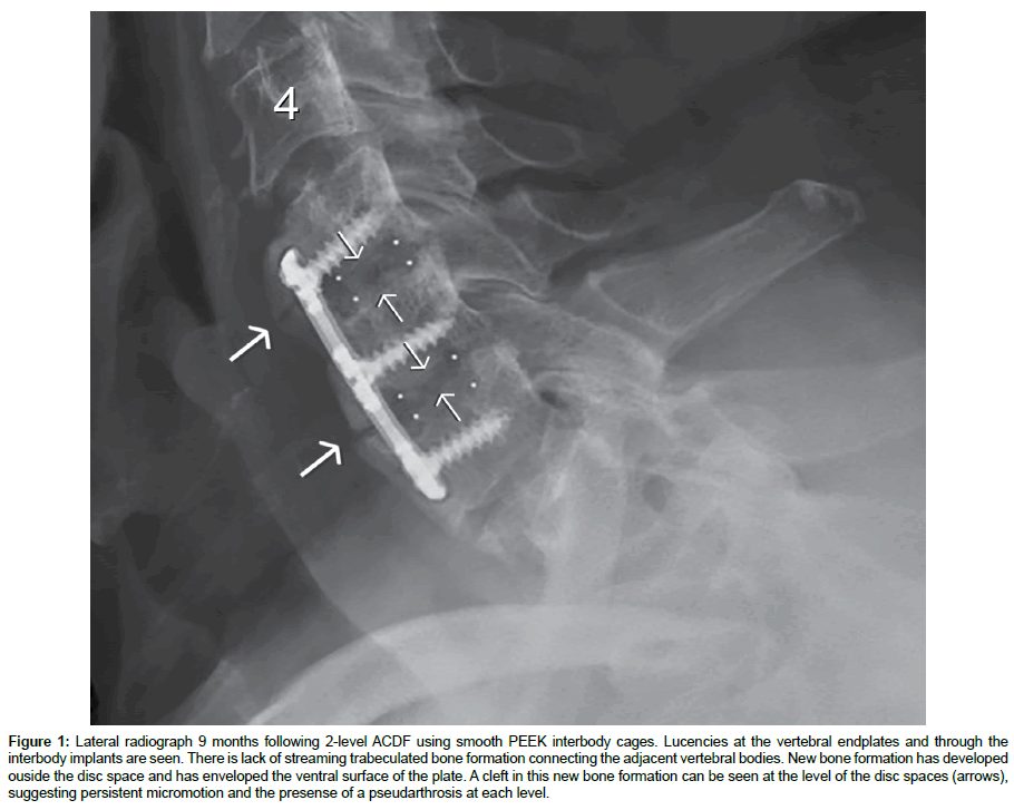 spine-neurosurgery-Lateral-radiograph