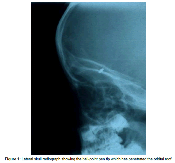 spine-neurosurgery-Lateral-skull