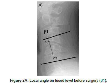 spine-neurosurgery-Local-angle