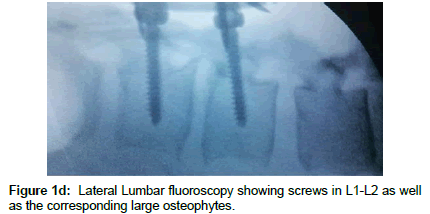 spine-neurosurgery-Lumbar-fluoroscopy