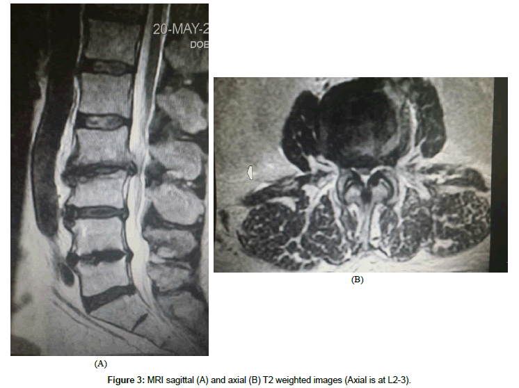 spine-neurosurgery-MRI-sagittal
