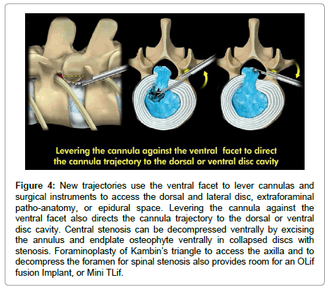 spine-neurosurgery-New-trajectories