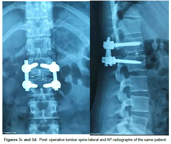 spine-neurosurgery-Post-operative
