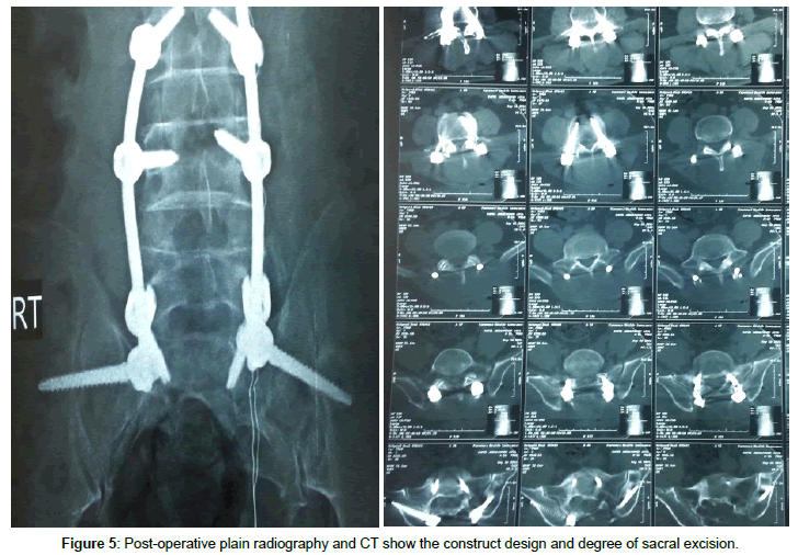 spine-neurosurgery-Post-operative