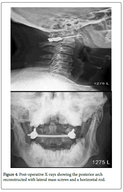 spine-neurosurgery-Post-operative