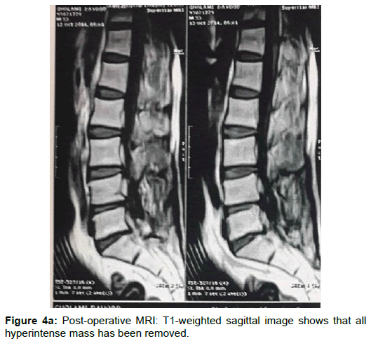spine-neurosurgery-Post-operative-MRI