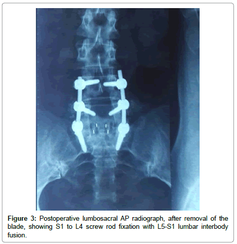 spine-neurosurgery-Postoperative-lumbosacral