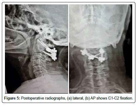 spine-neurosurgery-Postoperative-radiographs