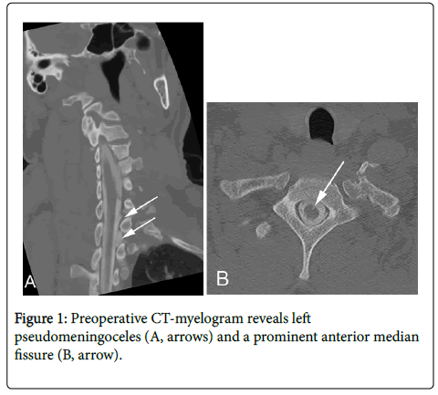 spine-neurosurgery-Preoperative-CT