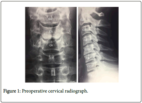 spine-neurosurgery-Preoperative-cervical