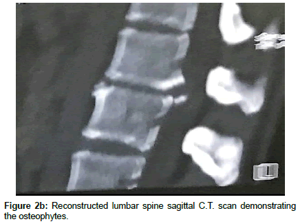 spine-neurosurgery-Reconstructed-lumbar