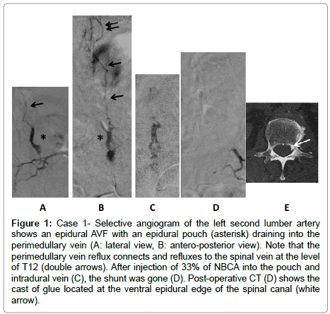 spine-neurosurgery-Selective-angiogram