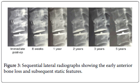spine-neurosurgery-Sequential-lateral