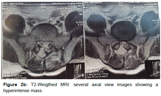 spine-neurosurgery-T2-Weigthed-MRI