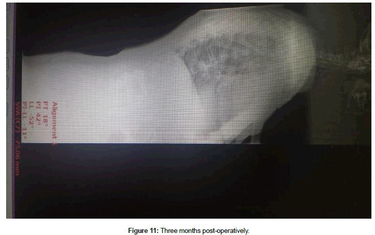 spine-neurosurgery-Three-months