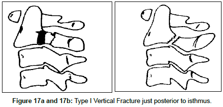 spine-neurosurgery-Vertical-Fracture