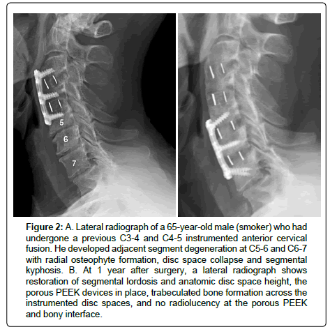 spine-neurosurgery-anterior-cervical