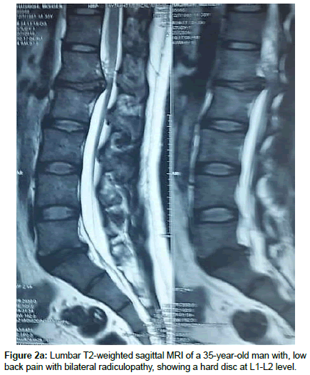 spine-neurosurgery-back-pain