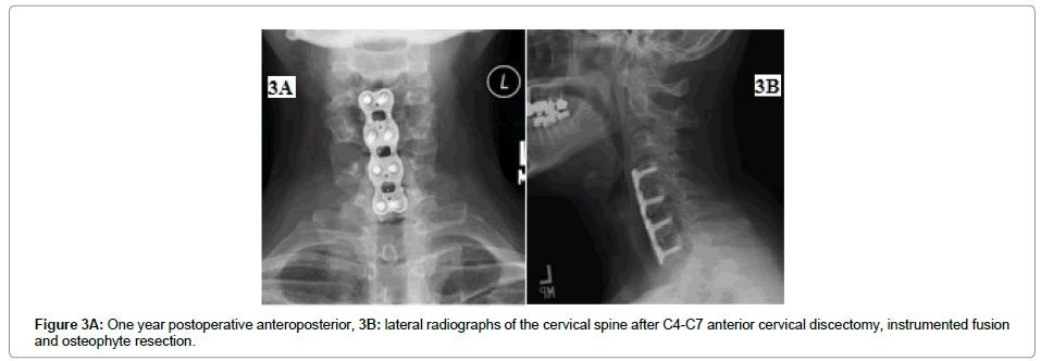 spine-neurosurgery-cervical-discectomy