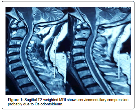 spine-neurosurgery-cervicomedullary