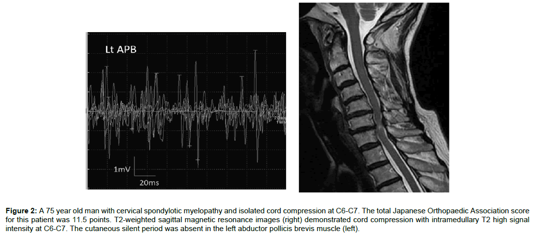 spine-neurosurgery-cord-compression