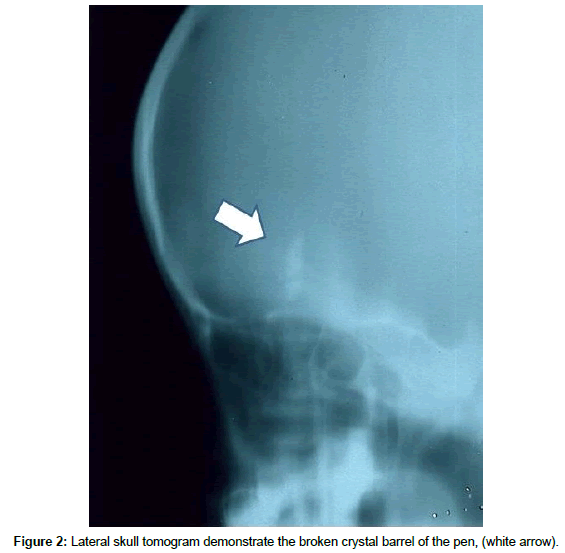 spine-neurosurgery-crystal-barrel