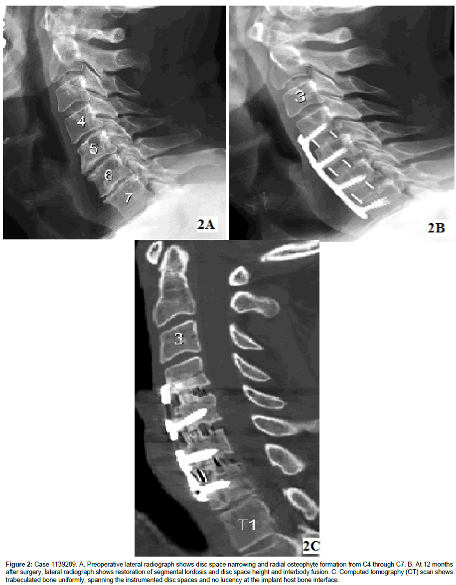 spine-neurosurgery-disc-space