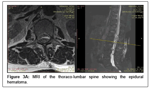 spine-neurosurgery-epidural