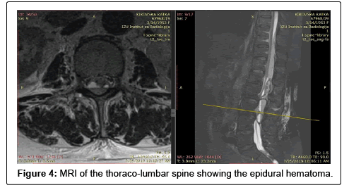 spine-neurosurgery-epidural