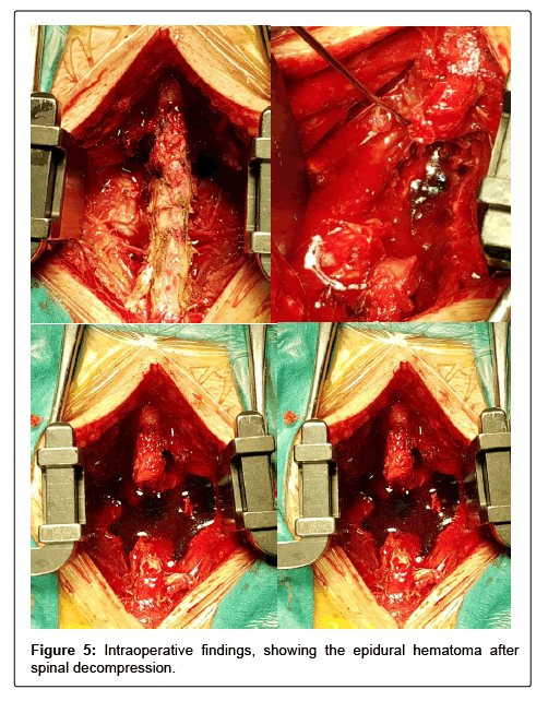 spine-neurosurgery-findings