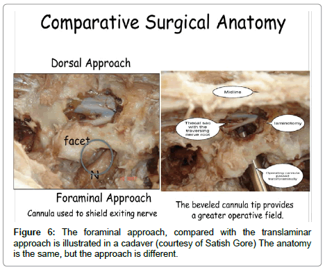 spine-neurosurgery-foraminal-approach