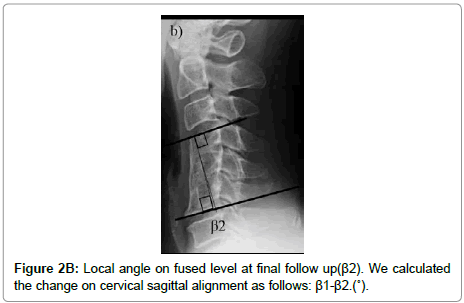 spine-neurosurgery-fused-level