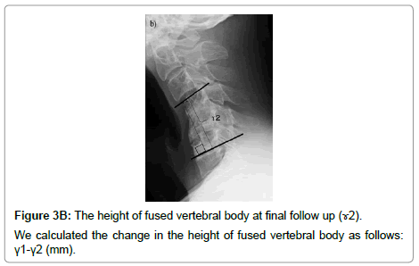 spine-neurosurgery-fused-vertebral