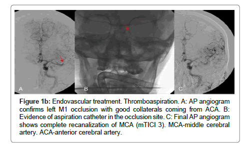 spine-neurosurgery-good-collaterals