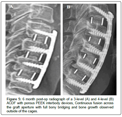 spine-neurosurgery-graft-aperture