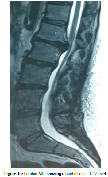 spine-neurosurgery-hard-disc
