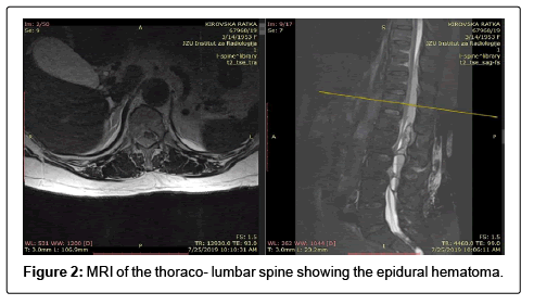 spine-neurosurgery-hematoma