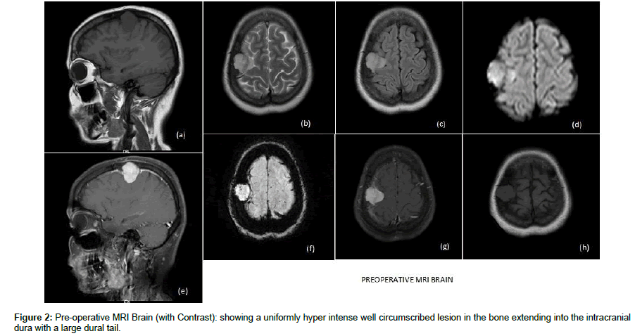 spine-neurosurgery-hyper-intense