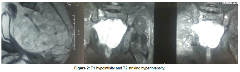 spine-neurosurgery-hyperintensity