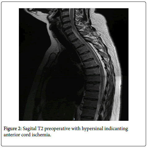 spine-neurosurgery-hypersinal-indicanting