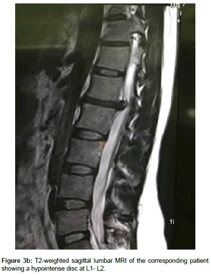spine-neurosurgery-hypointense-disc